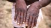 Marcas na pele provocadas por varíola do macaco em paciente em fase de recuperação, em foto de arquivo de 1997, na República Democrática do Congo