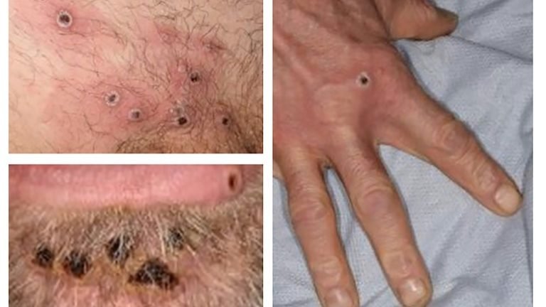 OMS pede vigilância e transparência ante varíola do macaco OMS pede vigilância e transparência ante varíola do macaco
