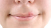 A herpes é caracterizada pelo surgimento de bolhas pequenas e doloridas nos lábios, gengivas, língua, céu da boca e até no nariz, rosto, queixo e pescoço.